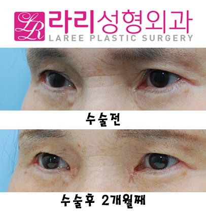 눈앞쪽 여러겹 쌍거풀없애기+뾰족한누호 둥글게 만들기 관련 이미지 5