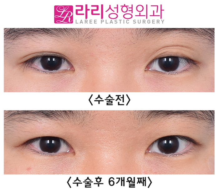 [Lari Plastic Surgery] Correcting a Severe Uneven Eye with Double Eyelid Removal Surgery image 4