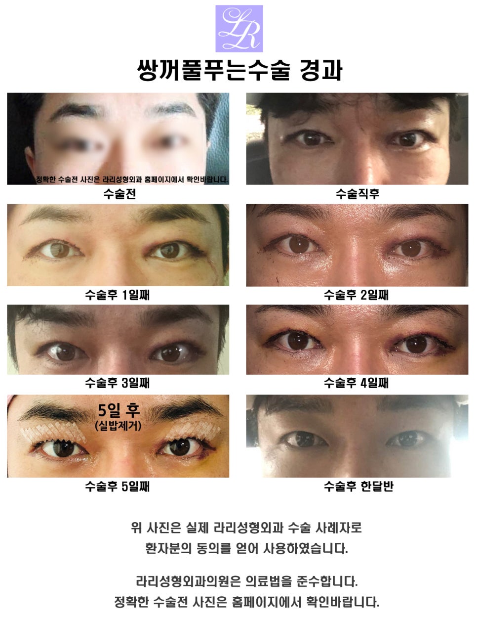 쌍꺼풀푸는수술이 쌍꺼풀없애는수술인가요? 관련 이미지 4