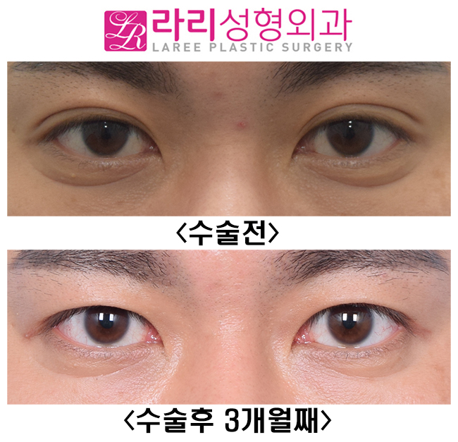 [라리성형외과] 원래 없었던 것처럼 보이는 자연쌍꺼풀없애기 관련 이미지 1