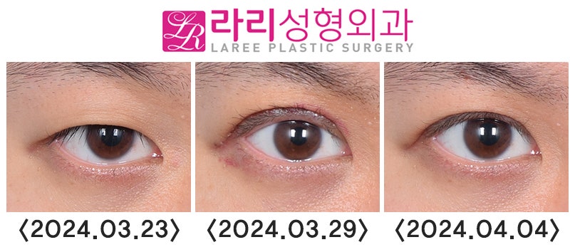 [라리성형외과] 쌍꺼풀수술 후 나타나는 안검외반 (상안검외반) 관련 이미지 2