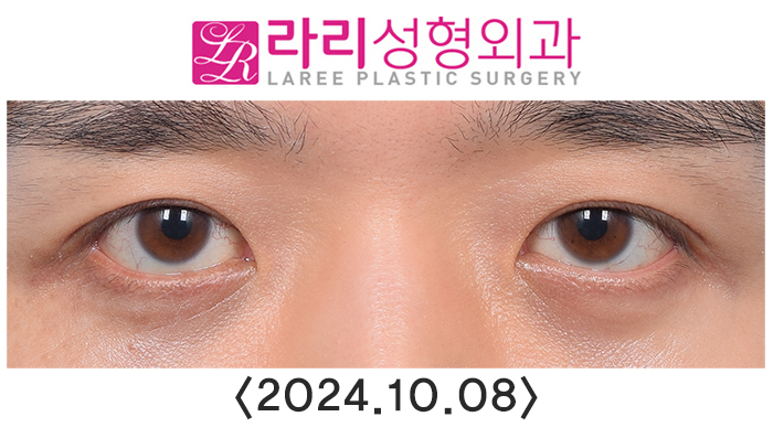[Lari Plastic Surgery] Double Eyelid Removal Surgery and Upper Eyelid Fat Grafting Surgery: Comparing Recovery and Swelling Over 6 Months image 5