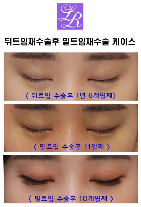 듀얼트임? 뒷트임? 밑트임? 수술 효과 및 재발가능성 관련 이미지 5