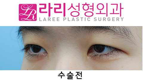 [라리성형외과] 절개쌍수 눈매교정 그리고 앞트임 관련 이미지 5