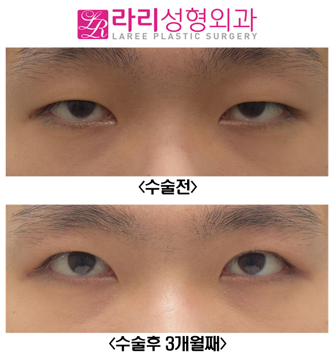 [라리성형외과] 남자 절개눈매교정 무쌍눈매교정 관련 이미지 1