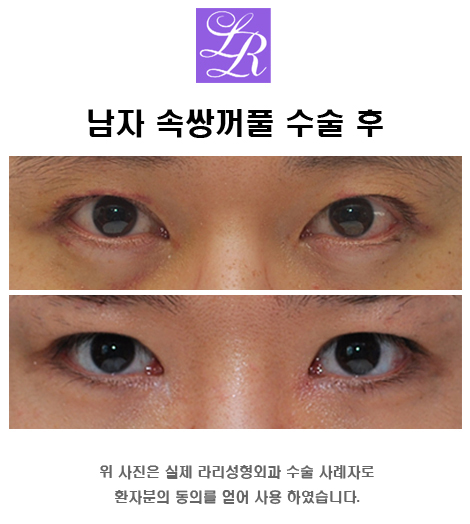 남자 눈도 뒷트임 할 수 있나요? 관련 이미지 2