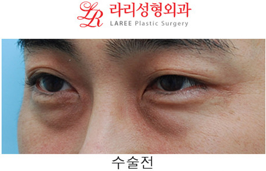 Under-Eye Fat Repositioning Before and After in Your 40s image 7