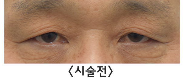 [라리성형외과] 이마 보톡스 효과 전후 사진 이마주름 얼마나 좋아지나 관련 이미지 1