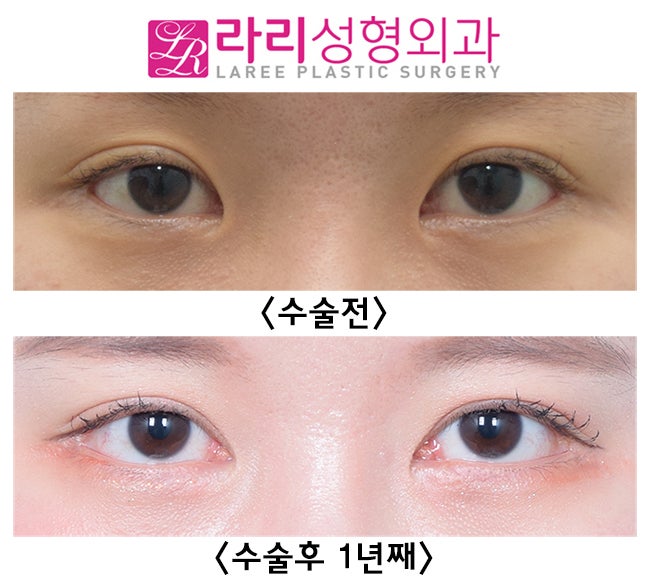 [Lari Plastic Surgery] Effective Revision Epicanthoplasty and Revision Canthoplasty: I Did Not Have Double Eyelid Surgery! image 1
