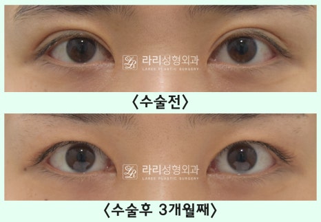 [Lari Plastic Surgery] Removing a Visible Double Eyelid (Double Eyelid Reversal Surgery), From Natural Double Eyelids to Surgical Double Eyelids: A to Z image 14