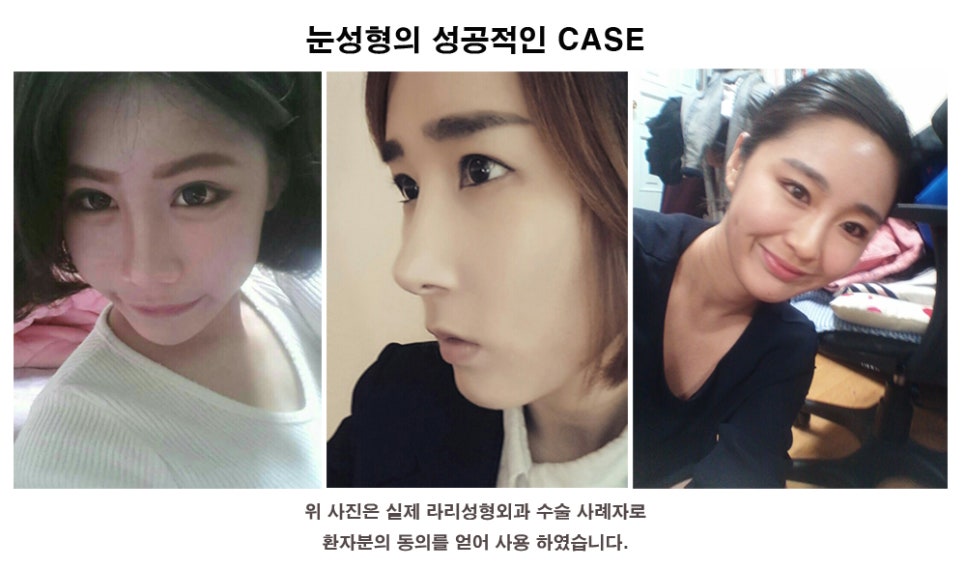 뒤트임재수술 - 첫수술이 효과가 없던 경우, 부작용? 관련 이미지 7