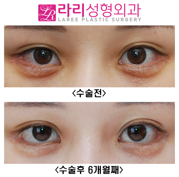 [Rari Plastic Surgery] If You Want a Successful Lower Canthoplasty, NO to Aegyo Filler image 1