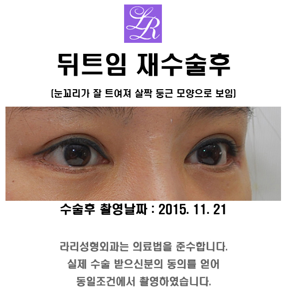 눈 뒤트임에 대한 오해 (feat. 부작용?) 관심있다면 꼭 봐주세요! 관련 이미지 5