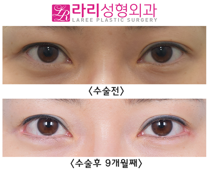 [Lari Plastic Surgery] The first surgery progress for outer corner lowering canthoplasty is good. image 1