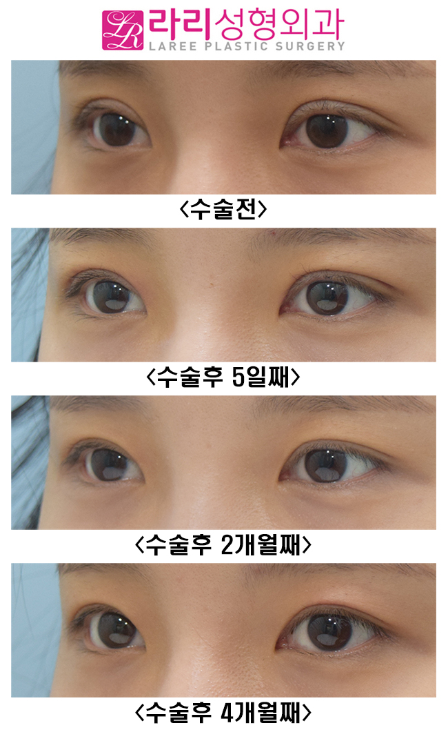 [Lari Plastic Surgery] Revision Double Eyelid Surgery to Correct Mucosal Exposure Caused by Sausage-Like Eyelids image 7