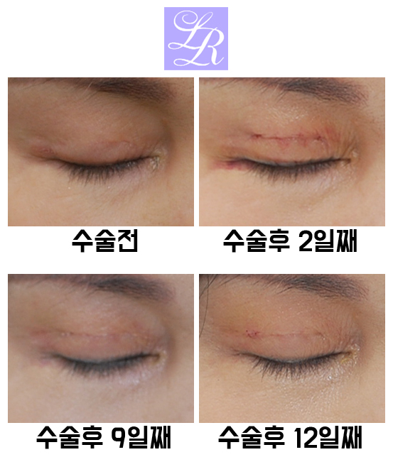 Revision Surgery to Raise the Buried Double Eyelid Line - Will It Change the Eye Shape? image 3