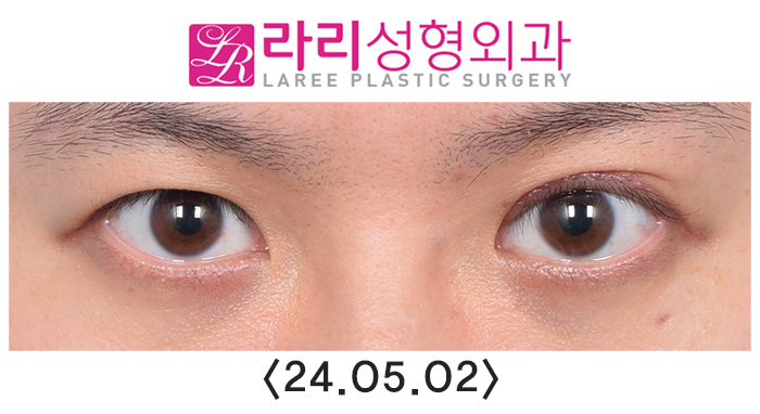 [라리성형외과] 쌍꺼풀없애는수술 후 필요에 의한 재교정과 회복 과정 기간별 사진 관련 이미지 5