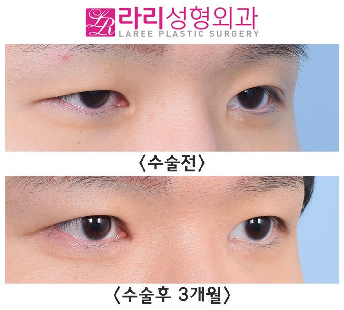 [Rari Plastic Surgery] Pre- and Post-Operation Photos of Uneven Double-Eyelid Correction and Double-Eyelid Removal on Different Sides image 4