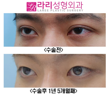 [Lari Plastic Surgery] Removing a Thick Natural Double Eyelid on Men image 3