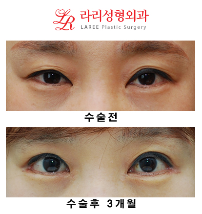 Revision Eyelid Surgery, Cases That Need Ptosis Correction, Correcting Asymmetry in Uneven Eyes image 2