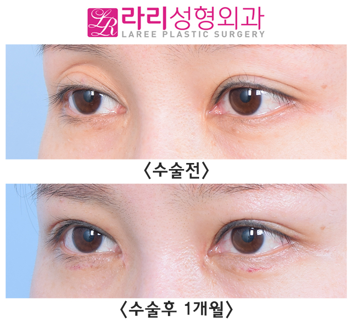 [라리성형외과] 피곤해 보이는 눈, 윗눈꺼풀 지방이식과 쌍수재수술로 예쁘게 재탄생 관련 이미지 3