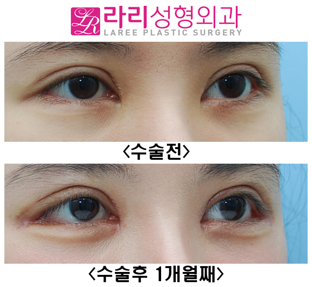 [라리성형외과] 눈매교정재수술 짝눈교정 뒤트임재수술 눈꼬리내리기 관련 이미지 2
