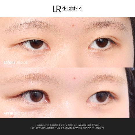 [라리성형외과] 쌍꺼풀수술 전후 사진으로 보는 눈매교정의 중요성 관련 이미지 1