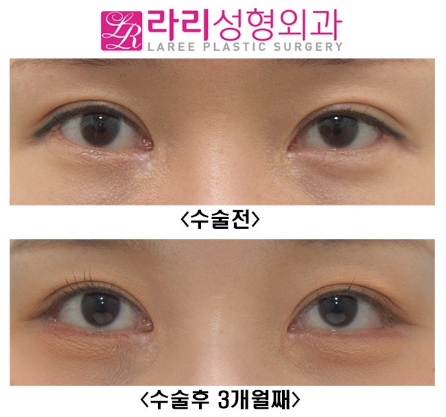 [Lari Plastic Surgery] If You Want to Be Sure of the Effect of Revision Lateral Canthoplasty, Do It Together with Revision Double Eyelid Surgery (Ptosis Correction Surgery). image 1