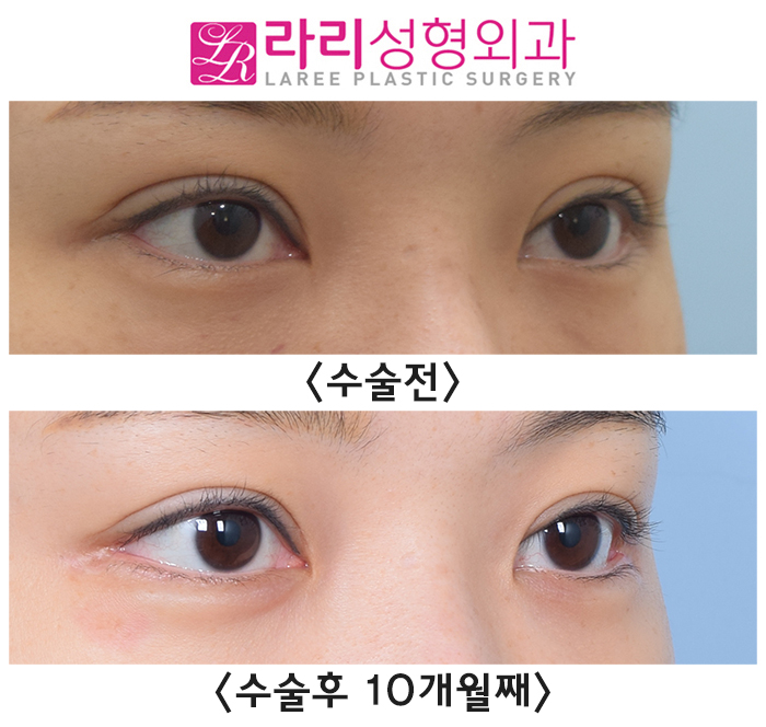 [Lari Plastic Surgery] Before-and-After Photos of Double Eyelid Revision Surgery and Lateral Canthoplasty Revision Surgery That Leave Nothing Out image 3