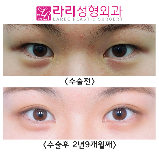 [라리성형외과] 쌍수와 앞트임으로 성숙한 이미지 만들기 관련 이미지 1