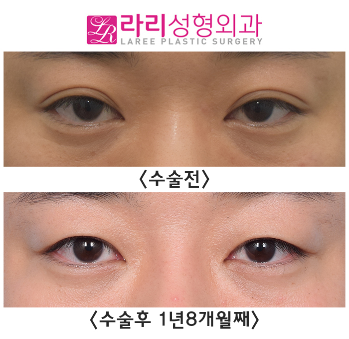 [Rari Plastic Surgery] Before and after surgery: removing a poorly lifting natural double eyelid to transform into a handsome-looking eye image 3