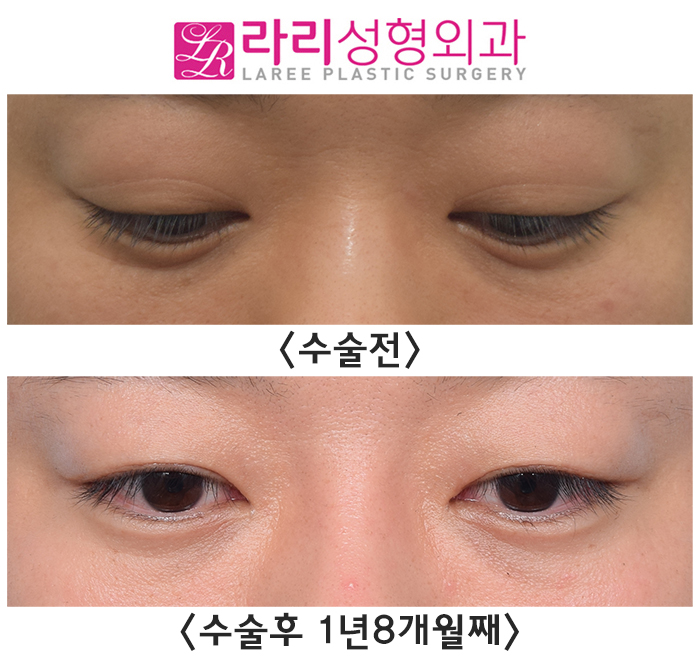 [Rari Plastic Surgery] Before and after surgery: removing a poorly lifting natural double eyelid to transform into a handsome-looking eye image 4
