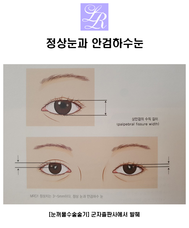 Stitch Removal After Non-Incisional Eye Correction image 1