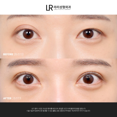 [라리성형외과] 눈 (재) 수술은 라리성형외과가 관련 이미지 8