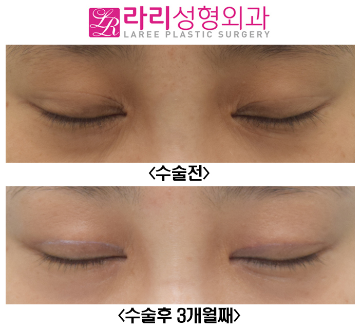 [라리성형외과] 쌍꺼풀 짝짝이, 쌍꺼풀 비대칭 교정 수술 전후 관련 이미지 2
