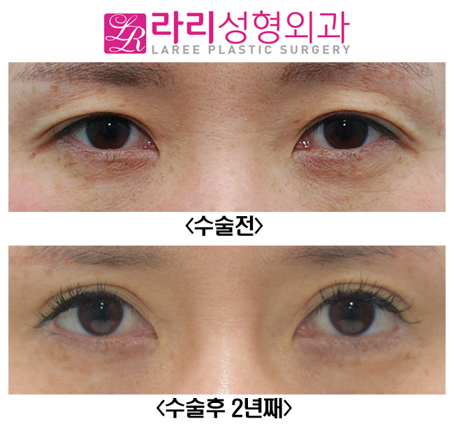 [라리성형외과] 아웃라인 쌍꺼풀재수술 화려하게 변화주기 관련 이미지 1