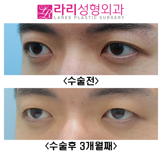 [Lari Plastic Surgery] Before-and-After Photos of Male Double Eyelid Removal Surgery at 3 Months image 5