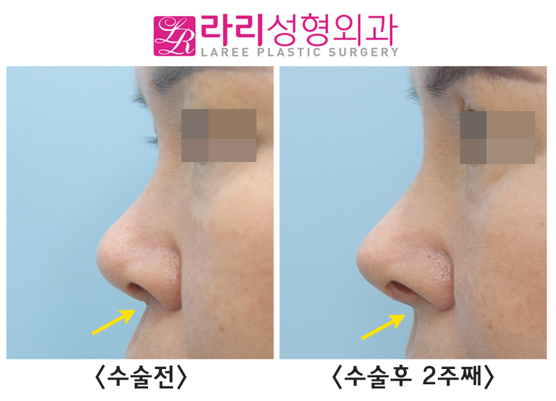 [라리성형외과] 코재수술, 입툭튀를 개선하는 고양이수술 효과 전후 사진 관련 이미지 5