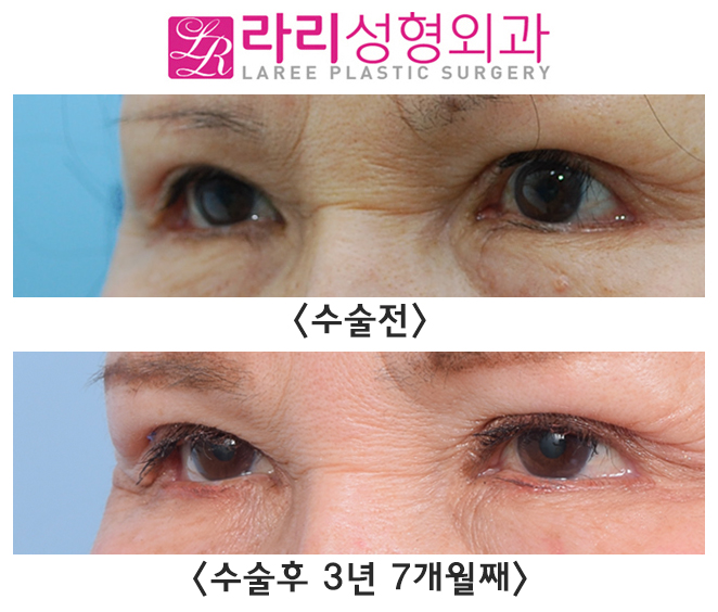 [Rari Plastic Surgery] Opening Your Eyes More Comfortably with Ptosis Correction image 3