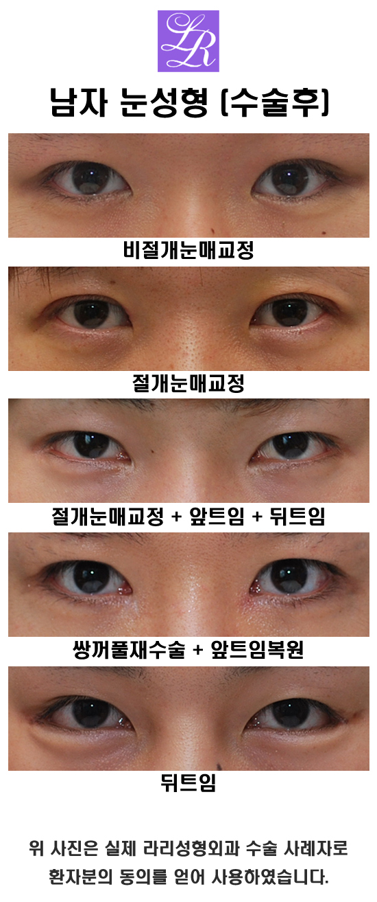Male Epicanthoplasty - Can It Be Done Together with Canthoplasty? image 2