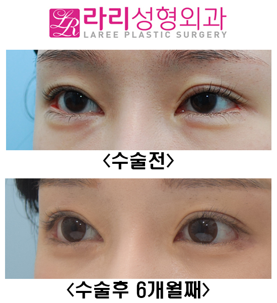 [Rari Plastic Surgery] Canthoplasty Revision Surgery, Entropion Surgery, Under-Eye Fat Repositioning Before-and-After Photos image 3