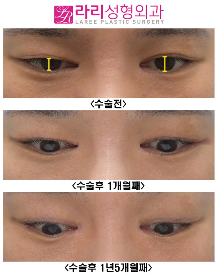[Rari Plastic Surgery] Watching the Progress Before and After Double Eyelid Removal Surgery image 3