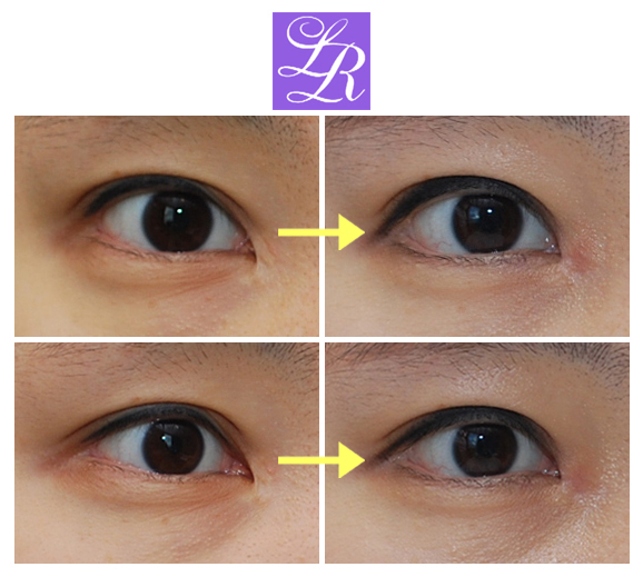 Long-Term Follow-Up Review Confirming the Effect of Lower Canthoplasty image 3
