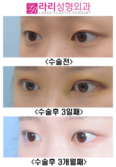 [라리성형외과] 흉터 없이 말끔한 매몰 쌍수 어때요? 관련 이미지 4