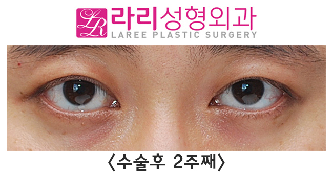 [라리성형외과] 쌍꺼풀없애는수술 단기 회복부터 장기 경과까지 관련 이미지 4