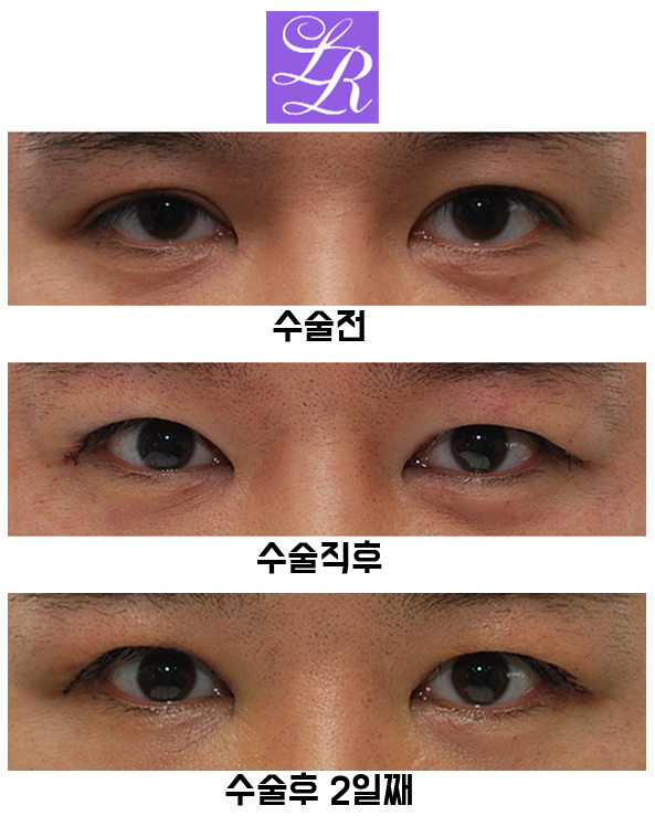 Review of Double Eyelid Reversal Surgery - Day 2 After Surgery, Swelling After Double Eyelid Surgery image 3