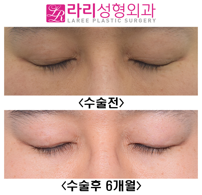 [라리성형외과] 눈을 떠도 눈을 감아도 쌍꺼풀이 없는 쌍꺼풀없애기 관련 이미지 2