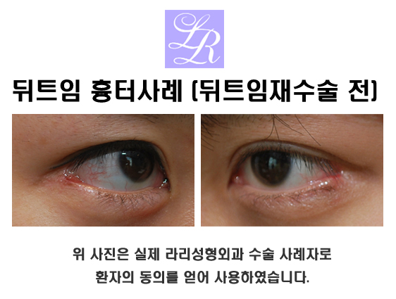 Where is the best place for revision canthoplasty? image 4