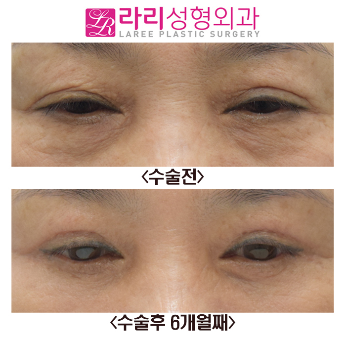 [라리성형외과] 상안검수술과 하안검수술 전후 사진 관련 이미지 2