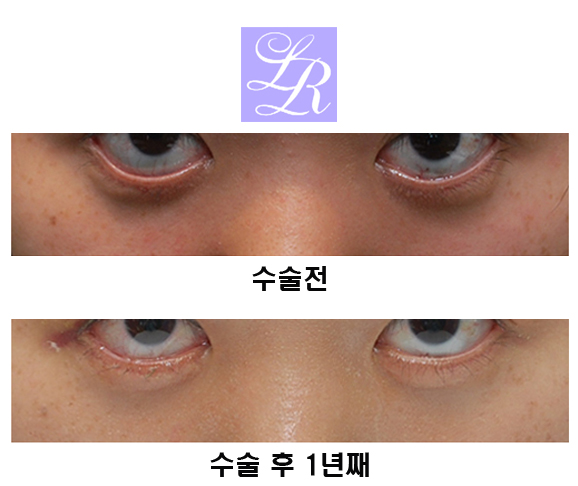 하안검수술,잘 알고 시행해야 관련 이미지 5